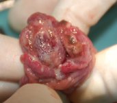 tumor operatie inet.jpg