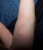 teeth marks.jpg
