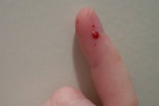 SnakeBite.jpg