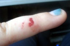 first adult snake bite.JPG